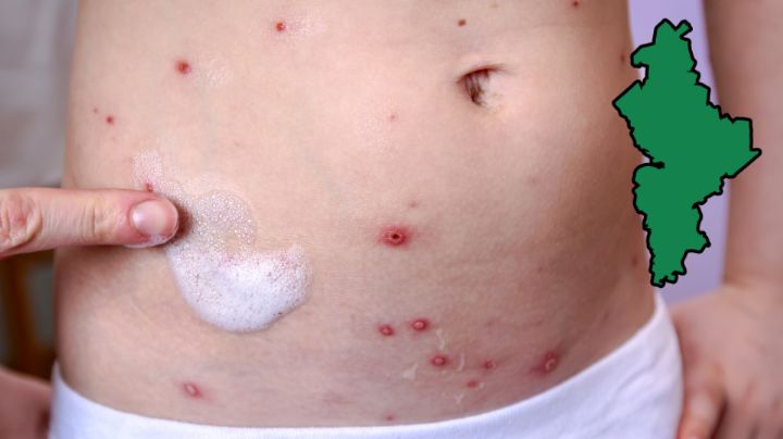 Nuevo León llega a 10 casos confirmados de sarampión