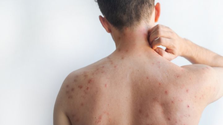 Suben a 40 los casos de sarampión en Nuevo León