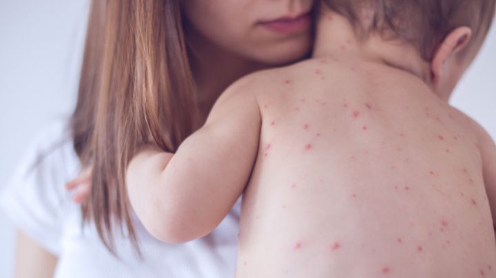 Suma Nuevo León 49 casos de sarampión