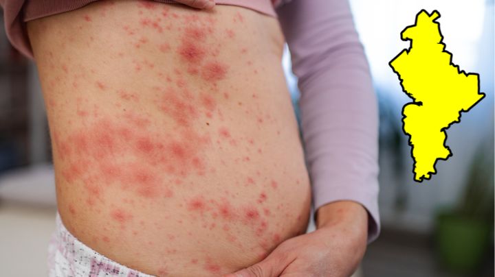 Aumentan a 36 los casos de sarampión en Nuevo León