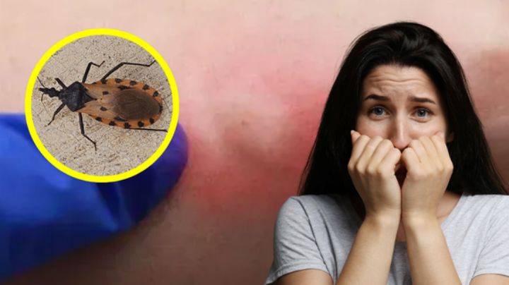 Chinches besuconas en NL: ¿Cómo identificar una picadura?