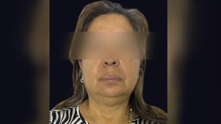 Mujer se hace pasar por doctora y amputa dedo a paciente en Querétaro